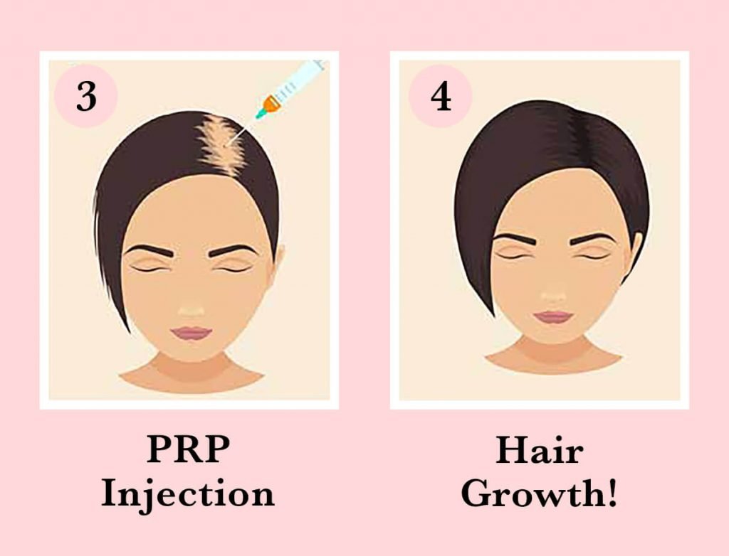 prf treatment for hair loss